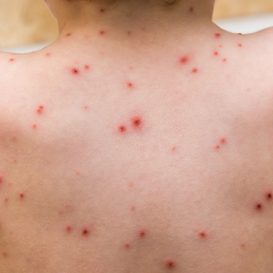 Natural Remedies for Chicken Pox: A Mother’s Story of Soothing with Skincare