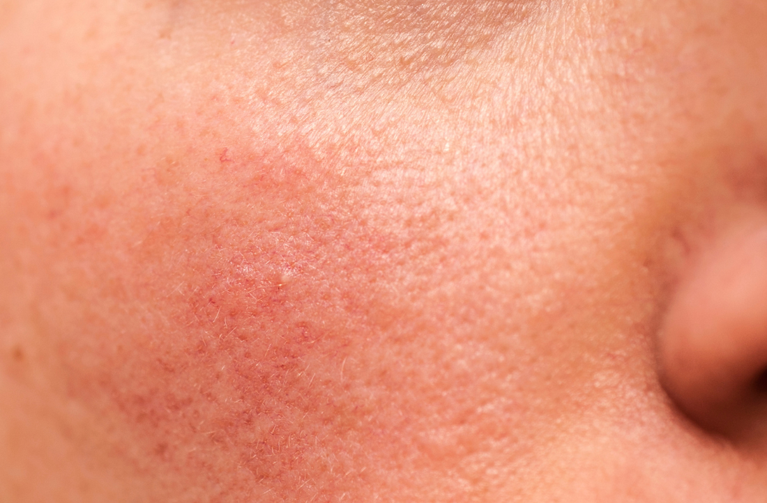 How To Care For Rosacea Prone Skin