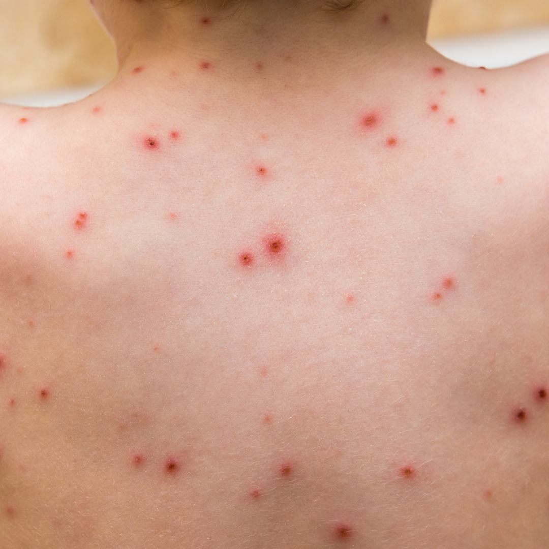 Close-up of a child's back with red chicken pox spots on the skin