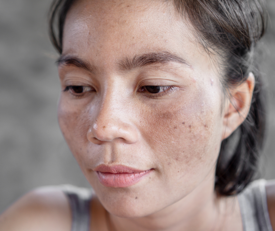 Skincare Advice: Hyperpigmentation