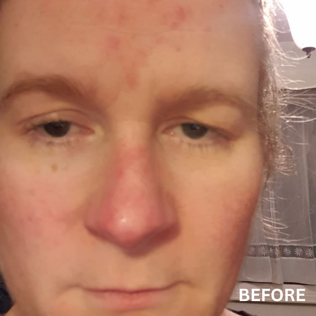 The Radiance | Natural Skincare for Rosacea-Prone, Red or Sensitive Skin