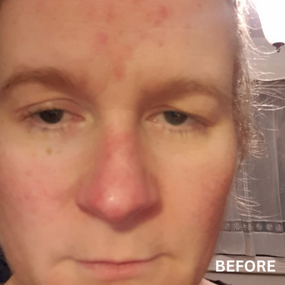 The Radiance | Natural Skincare for Rosacea-Prone, Red or Sensitive Skin