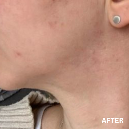 The Lustrous | Natural Skincare for Oily & Acne-Prone Skin