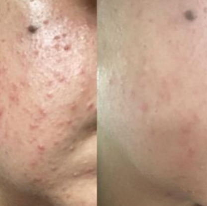 The Lustrous | Natural Skincare for Oily & Acne-Prone Skin