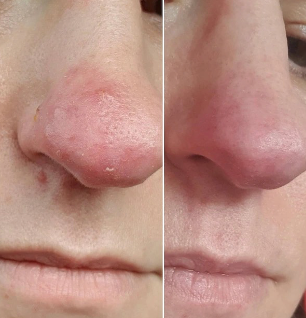 The Radiance | Natural Skincare for Rosacea-Prone, Red or Sensitive Skin