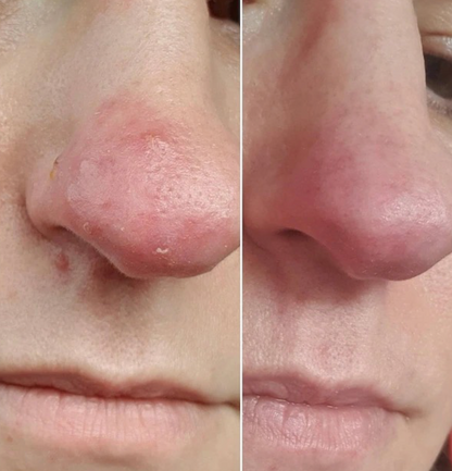 The Radiance | Natural Skincare for Rosacea-Prone, Red or Sensitive Skin